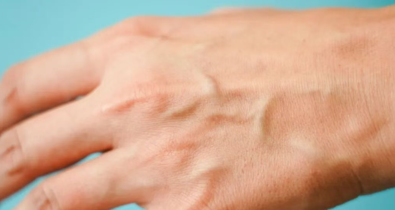 为什么有的人手上青筋暴起？这些地方出现青筋，一定要小心