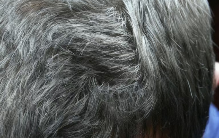 头上有这2种白发，必须排查疾病！很多人都不知道→
